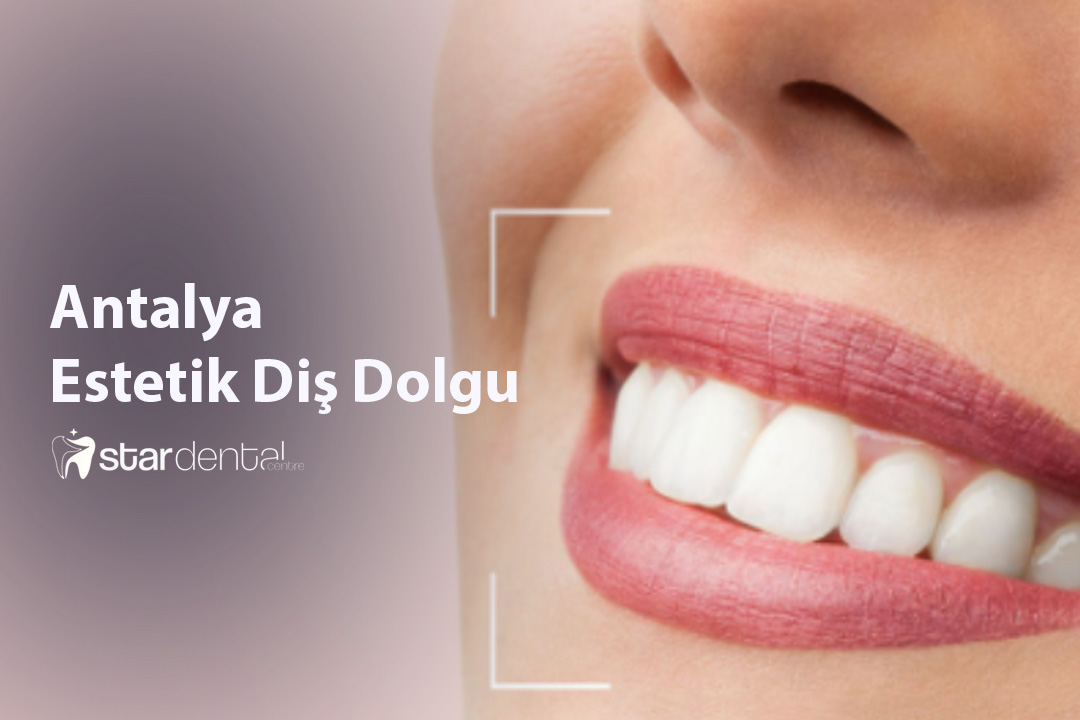 Antalya Estetik Dis Dolgu – Estetik Dis Hekimligi