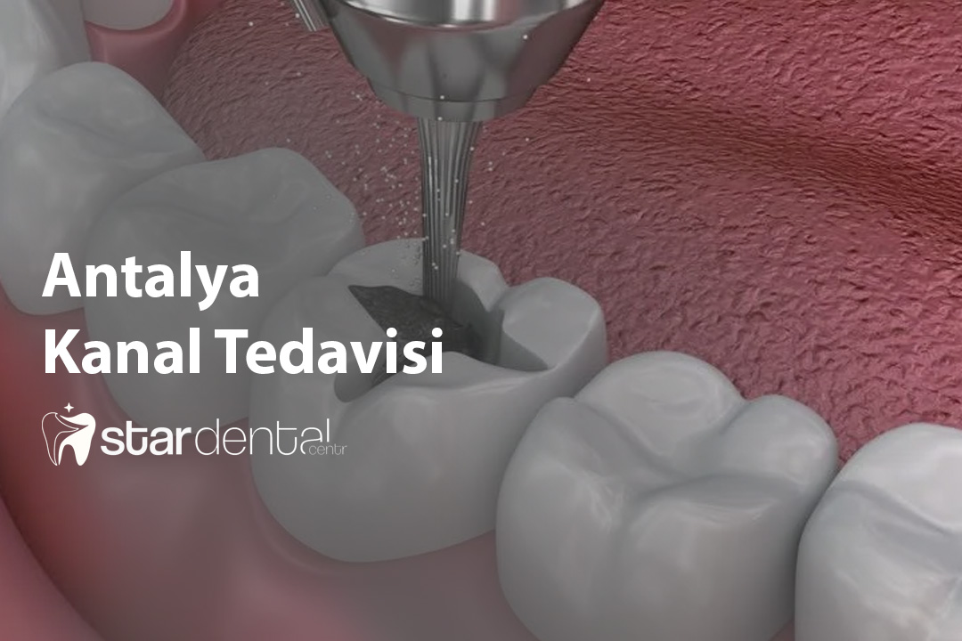 Antalya Kanal Tedavisi