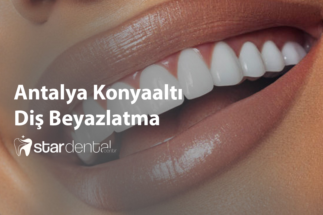 Antalya Konyaalti Dis Beyazlatma One Cikan