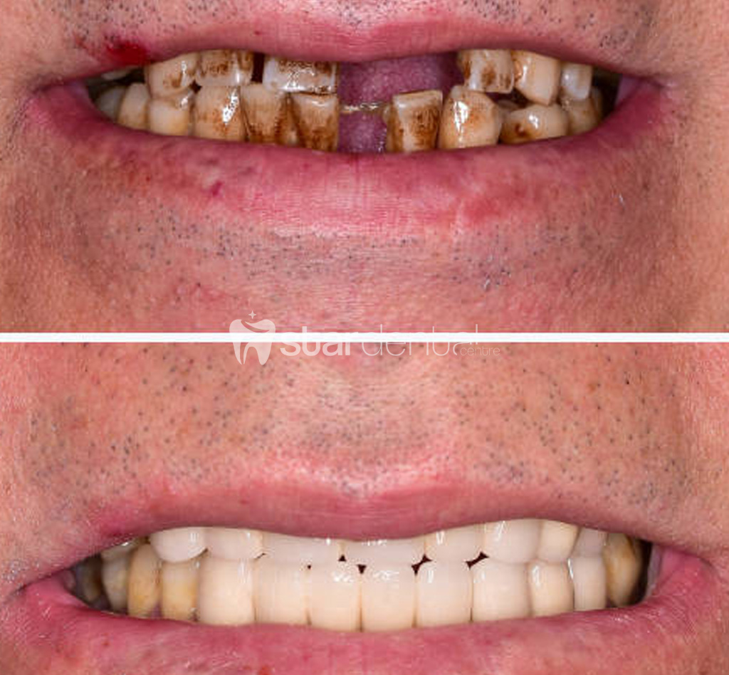 Implant Tedavisi Konyaalti Antalya 1