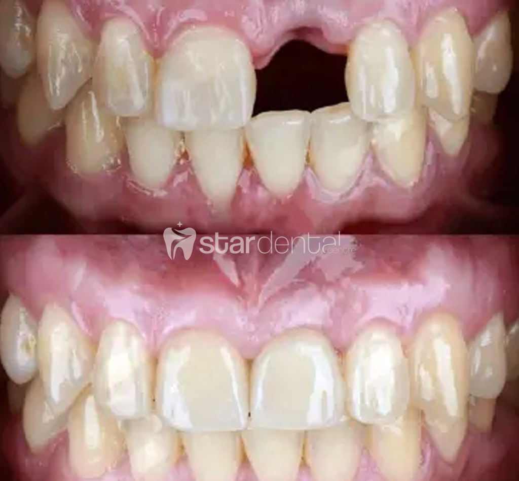 Implant Tedavisi Konyaalti Antalya 2
