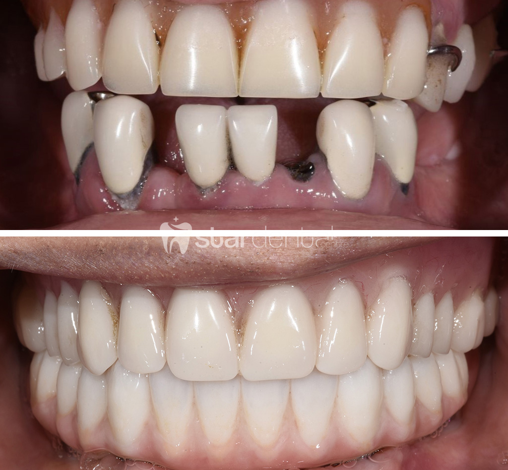 Implant Tedavisi Konyaalti Antalya 3