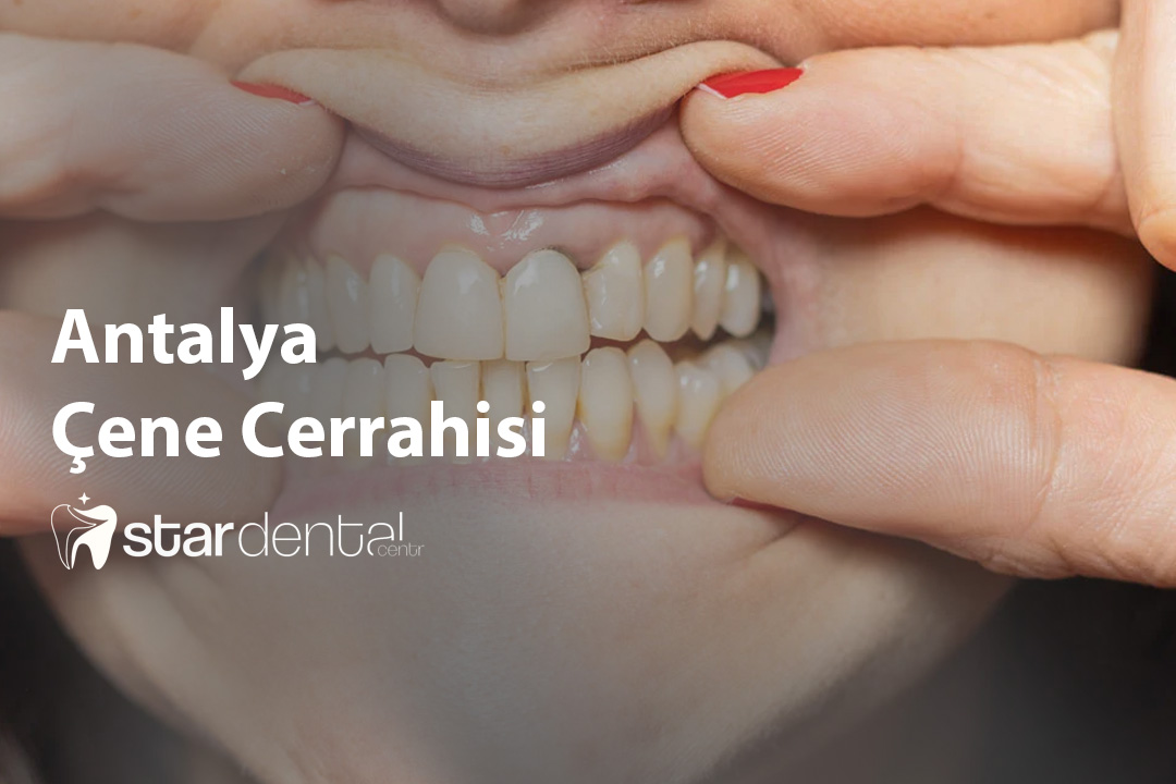 Antalya Çene Cerrahisi